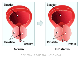 Prostatitis | Prostate pleasure and problems | CondomDepot.com Learning Center