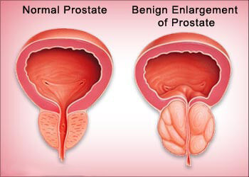 Benign Prostatic Hyperplasia | Prostate Pleasures and Problems | CondomDepot.com Learning Center