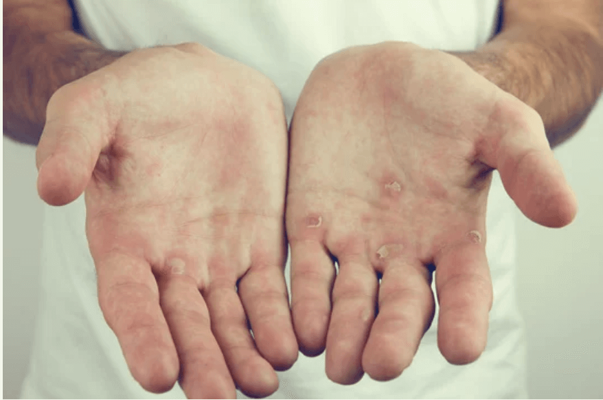 Calluses on Hand | Too Much Mastrubation | CondomDepot.com Learning Center